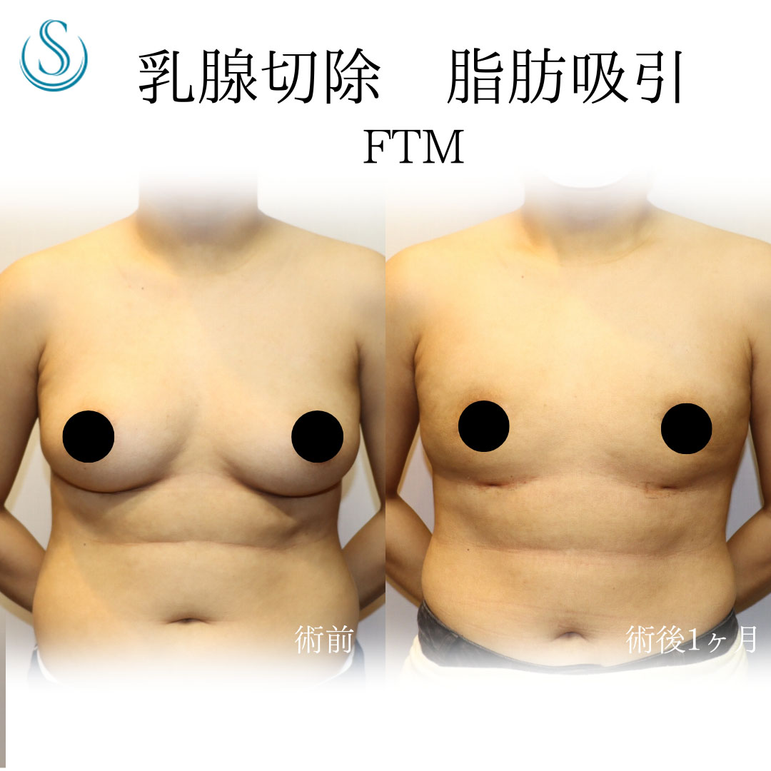 FTM 胸 FTMの胸オペ・ボディデザイン｜THE CLINIC （ザクリニック）【公式】