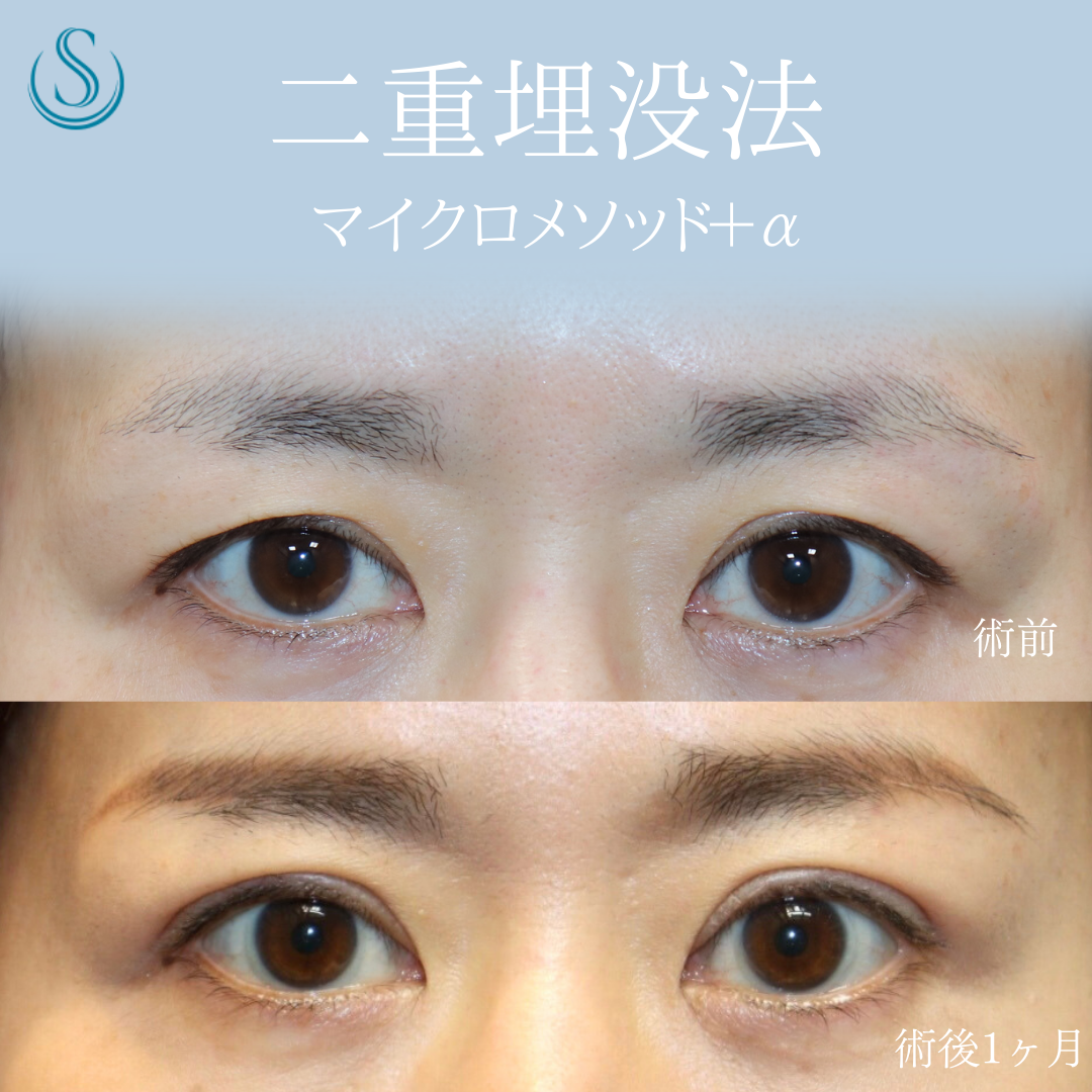 【40代女性・皮膚のかぶさりを埋没法で解除】二重術（埋没法）：マイクロメソッド+α（術後1ヶ月） Before 