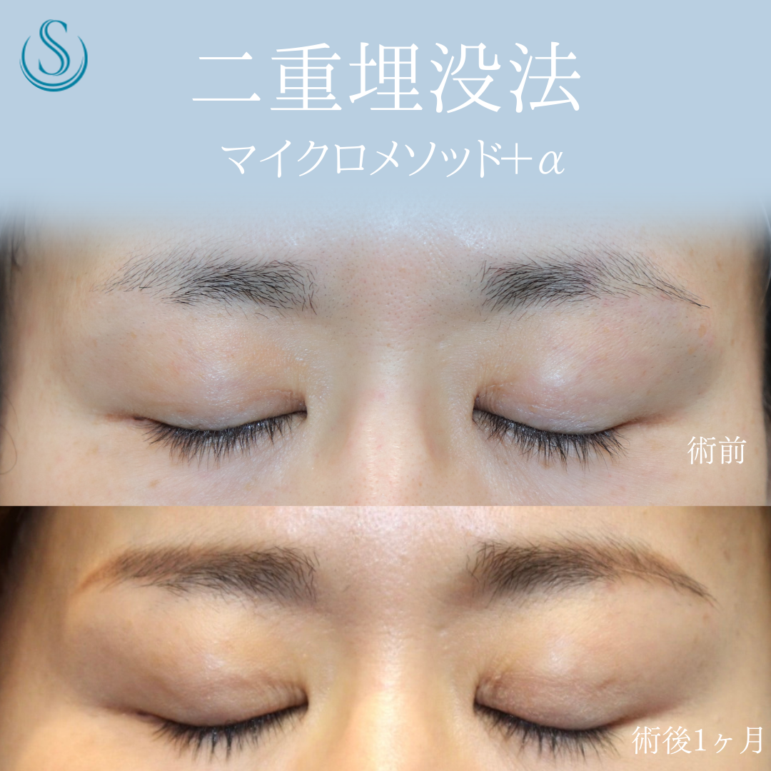 【40代女性・皮膚のかぶさりを埋没法で解除】二重術（埋没法）：マイクロメソッド+α（術後1ヶ月） After 