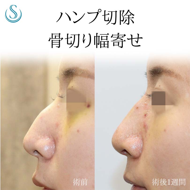 【30代女性・鷲鼻を修正する】鷲鼻修正（わし鼻修正、整鼻術・低鼻術）（1週間後） Before 