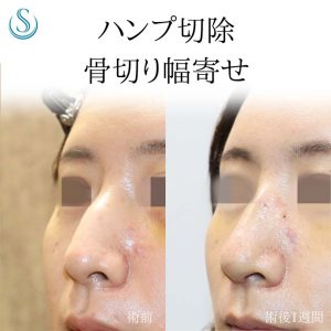 30代女性・鷲鼻を修正する】鷲鼻修正（わし鼻修正、整鼻術・低鼻術