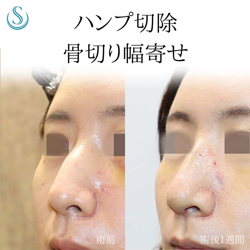 【30代女性・鷲鼻を修正する】鷲鼻修正（わし鼻修正、整鼻術・低鼻術）（1週間後） After 