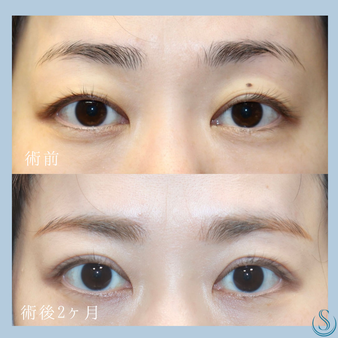【30代女性・二重をよりくっきりはっきりと】 二重術（埋没法）：マイクロメソッド+α（2ヶ月後） Before 