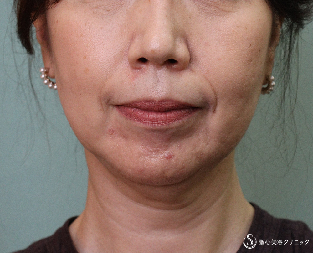 【50代女性・あご下のボリューム】FatX（ファットエックス）脂肪溶解注射（治療開始後4か月） After 