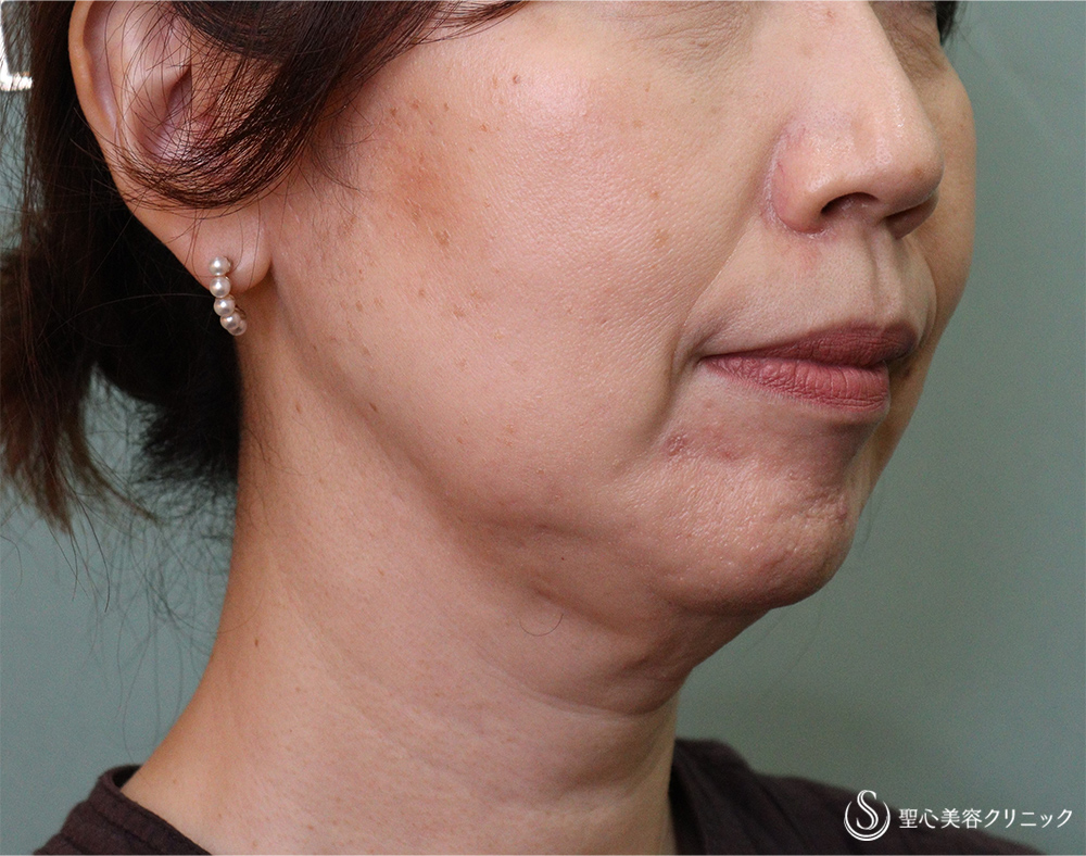 【50代女性・あご下のボリューム】FatX（ファットエックス）脂肪溶解注射（治療開始後4か月） After 