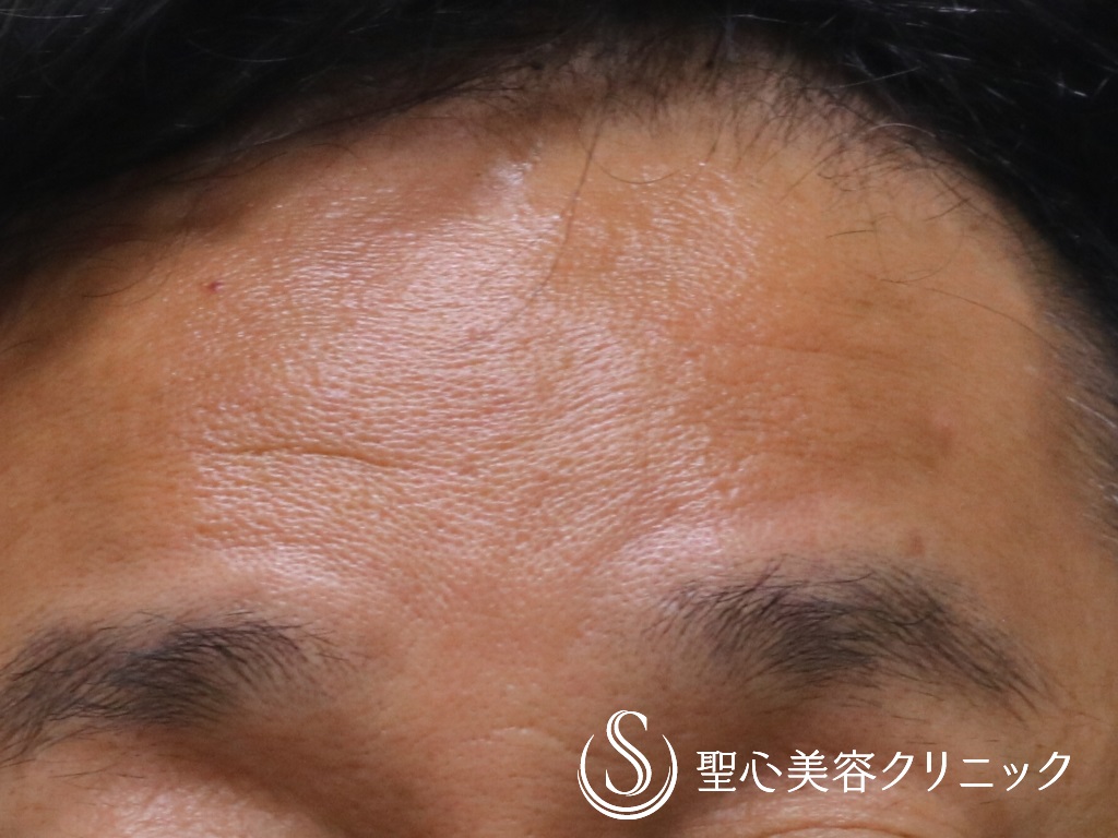 【50代男性・頑固な額のシワ治療】プレミアムPRP皮膚再生療法（術後6か月） After 