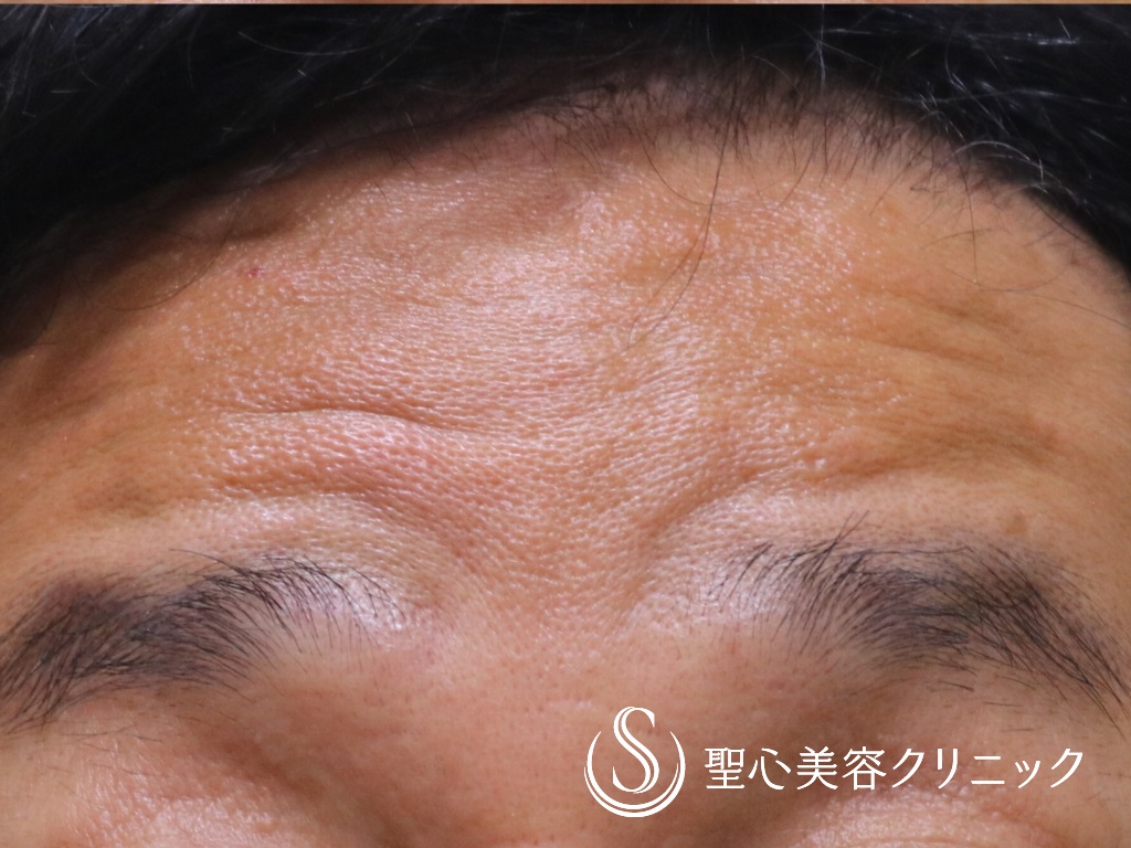 【50代男性・頑固な額のシワ治療】プレミアムPRP皮膚再生療法（術後6か月） After 