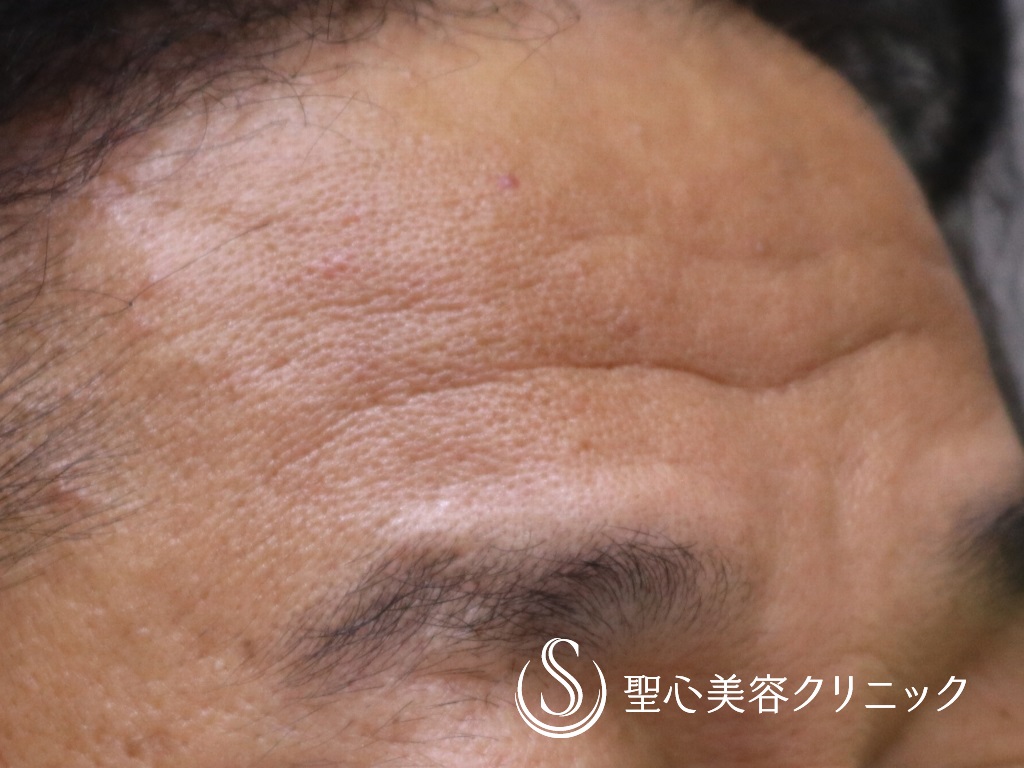 【50代男性・頑固な額のシワ治療】プレミアムPRP皮膚再生療法（術後6か月） Before 