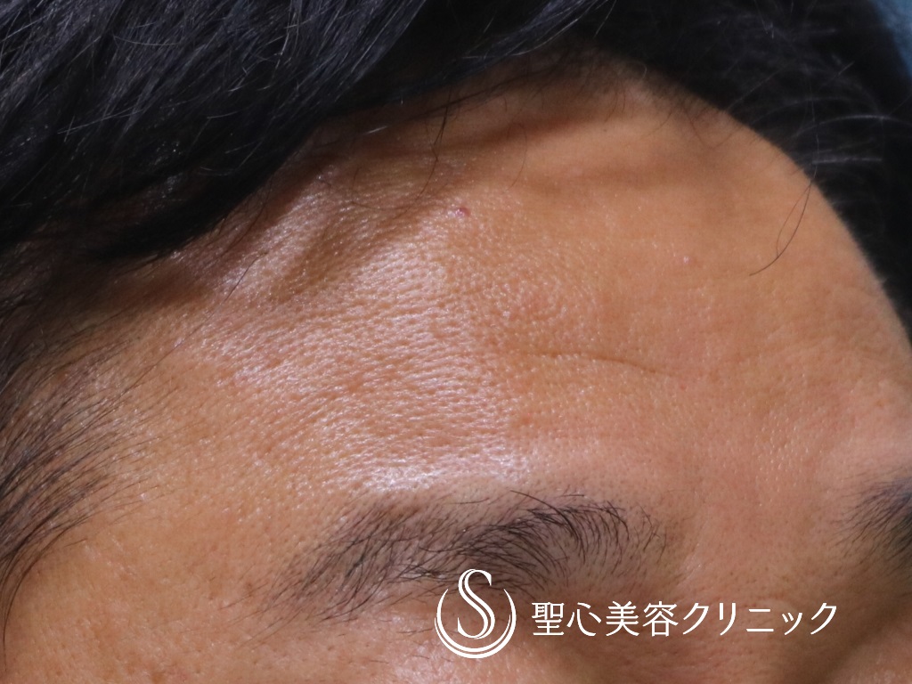 【50代男性・頑固な額のシワ治療】プレミアムPRP皮膚再生療法（術後6か月） After 