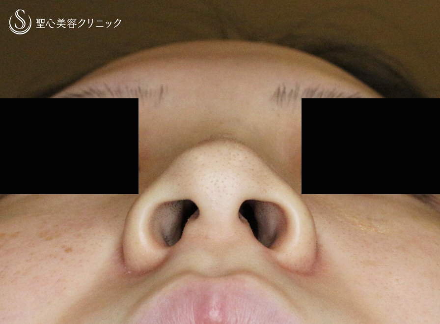 【20代女性・スマート小鼻で「忘れ鼻」】小鼻縮小術+α法 Ver.5.5（6ヶ月後） Before 