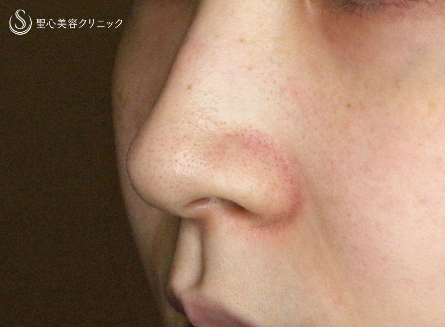 【20代女性・スマート小鼻で「忘れ鼻」】小鼻縮小術+α法 Ver.5.5（6ヶ月後） Before 