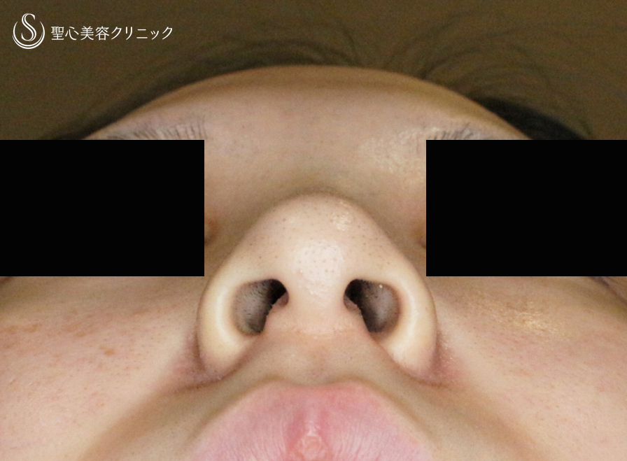 【20代女性・スマート小鼻で「忘れ鼻」】小鼻縮小術+α法 Ver.5.5（6ヶ月後） After 