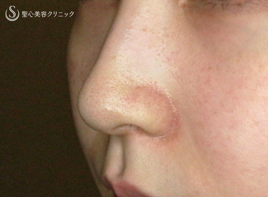 【20代女性・スマート小鼻で「忘れ鼻」】小鼻縮小術+α法 Ver.5.5（6ヶ月後） After 