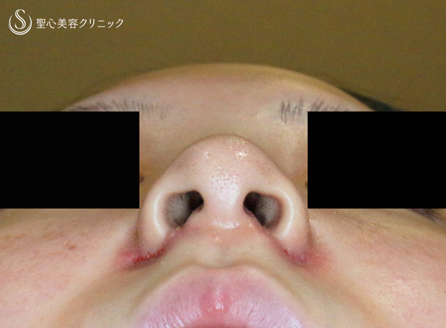 【20代女性・スマート小鼻で「忘れ鼻」】小鼻縮小術+α法 Ver.5.5（6ヶ月後） After 