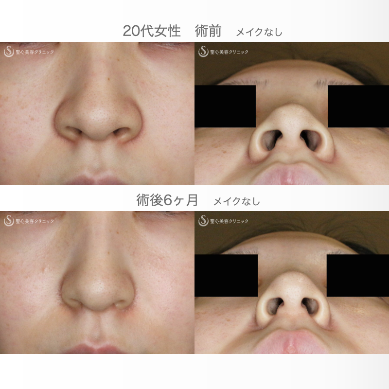【20代女性・スマート小鼻で「忘れ鼻」】小鼻縮小術+α法 Ver.5.5（6ヶ月後） Before 