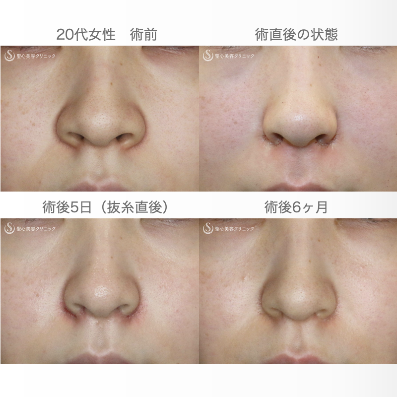 【20代女性・スマート小鼻で「忘れ鼻」】小鼻縮小術+α法 Ver.5.5（6ヶ月後） After 