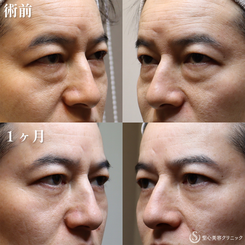 【40代男性・クマを取り、目の開きも良くなって一気に若返り】目の下の脂肪取り（経結膜下脱脂法）（1か月後） Before 