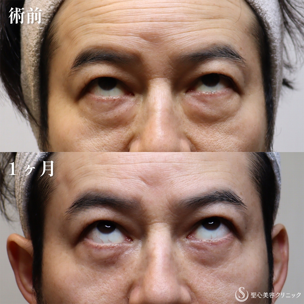 【40代男性・クマを取り、目の開きも良くなって一気に若返り】目の下の脂肪取り（経結膜下脱脂法）（1か月後） Before 