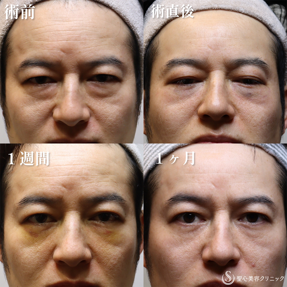 【40代男性・クマを取り、目の開きも良くなって一気に若返り】目の下の脂肪取り（経結膜下脱脂法）（1か月後） After 