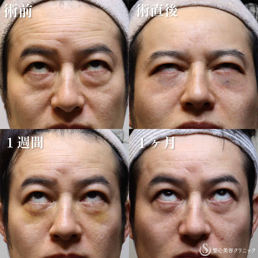 【40代男性・クマを取り、目の開きも良くなって一気に若返り】目の下の脂肪取り（経結膜下脱脂法）（1か月後） After 