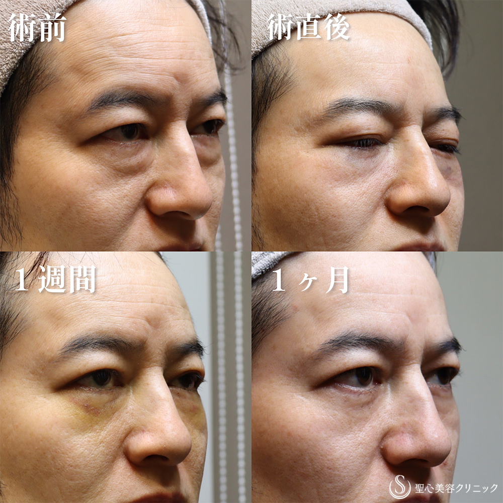 【40代男性・クマを取り、目の開きも良くなって一気に若返り】目の下の脂肪取り（経結膜下脱脂法）（1か月後） After 