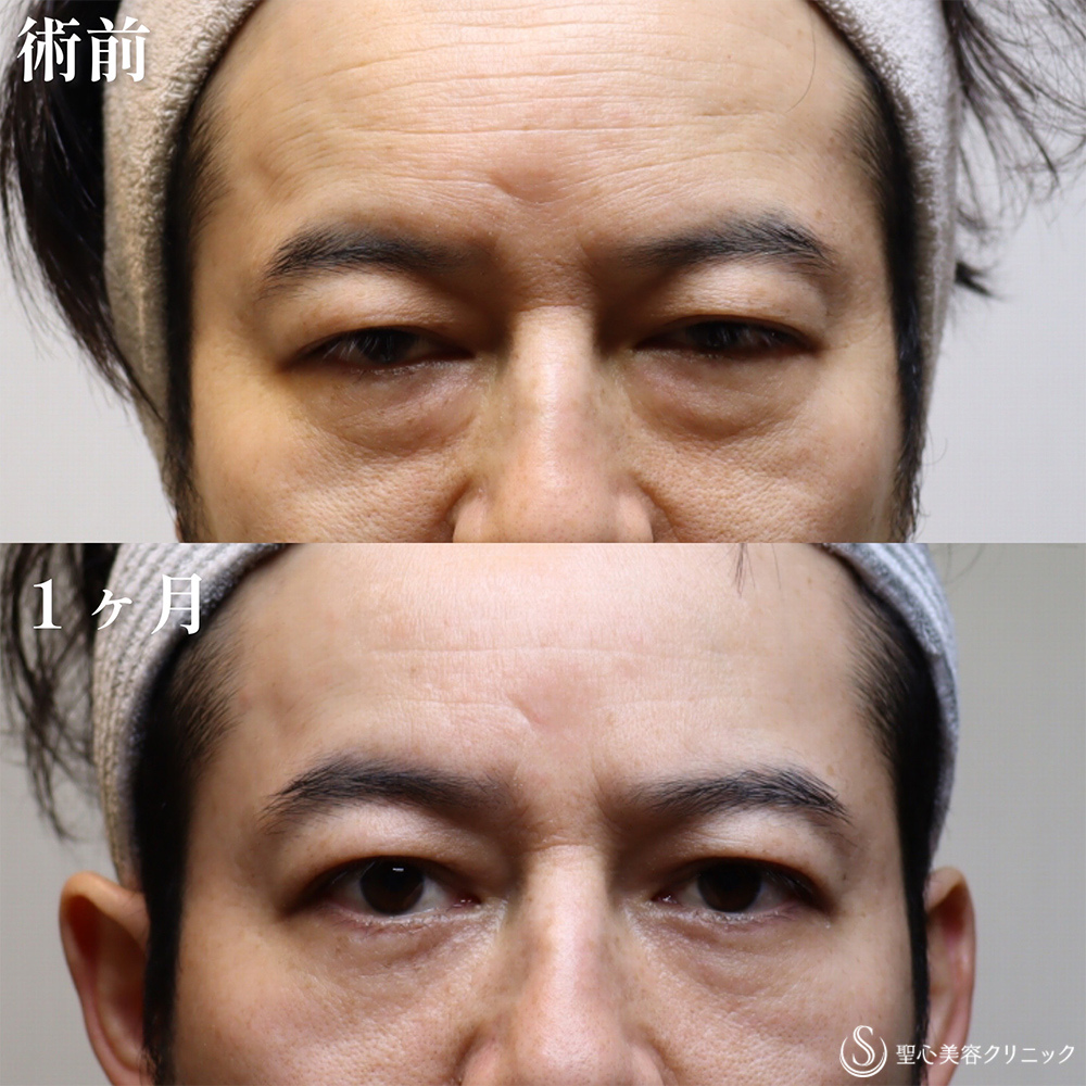 【40代男性・クマを取り、目の開きも良くなって一気に若返り】目の下の脂肪取り（経結膜下脱脂法）（1か月後） Before 