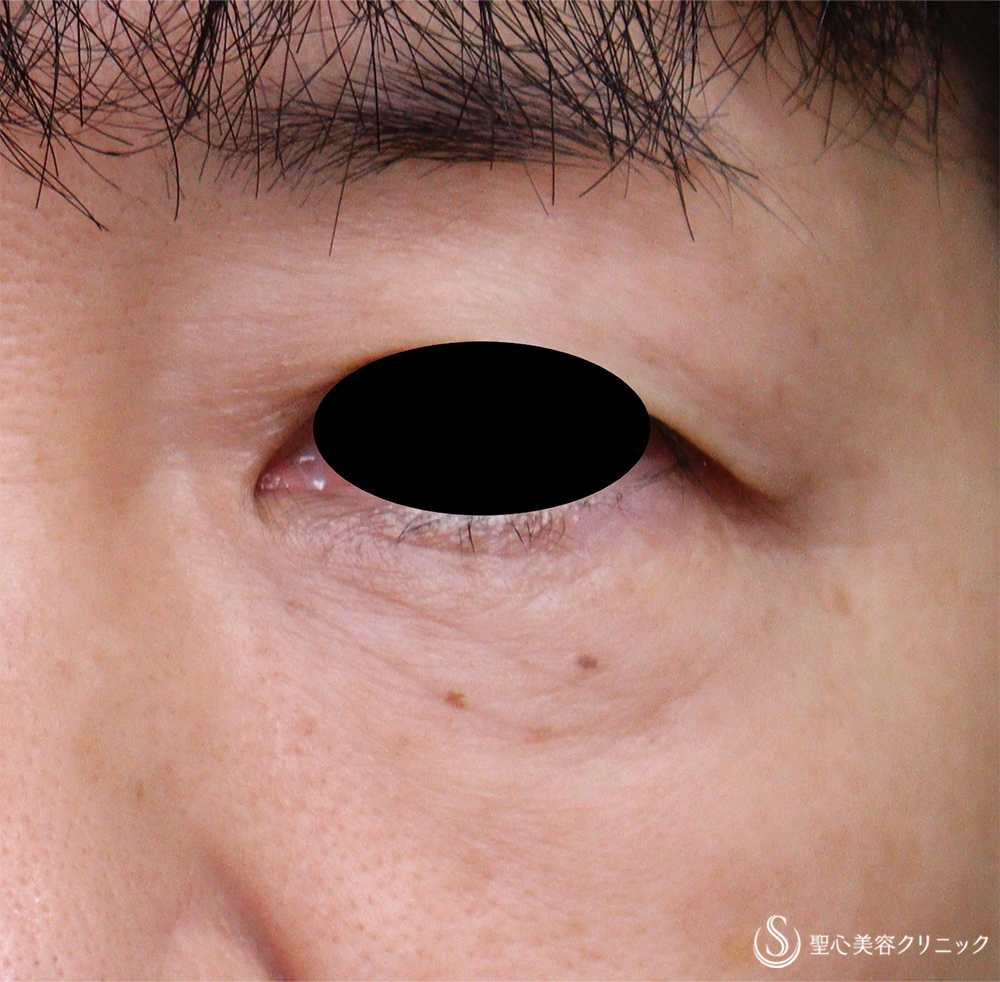 【50代女性・目の下の小じわ】プレミアムPRP皮膚再生療法（1年後） Before 