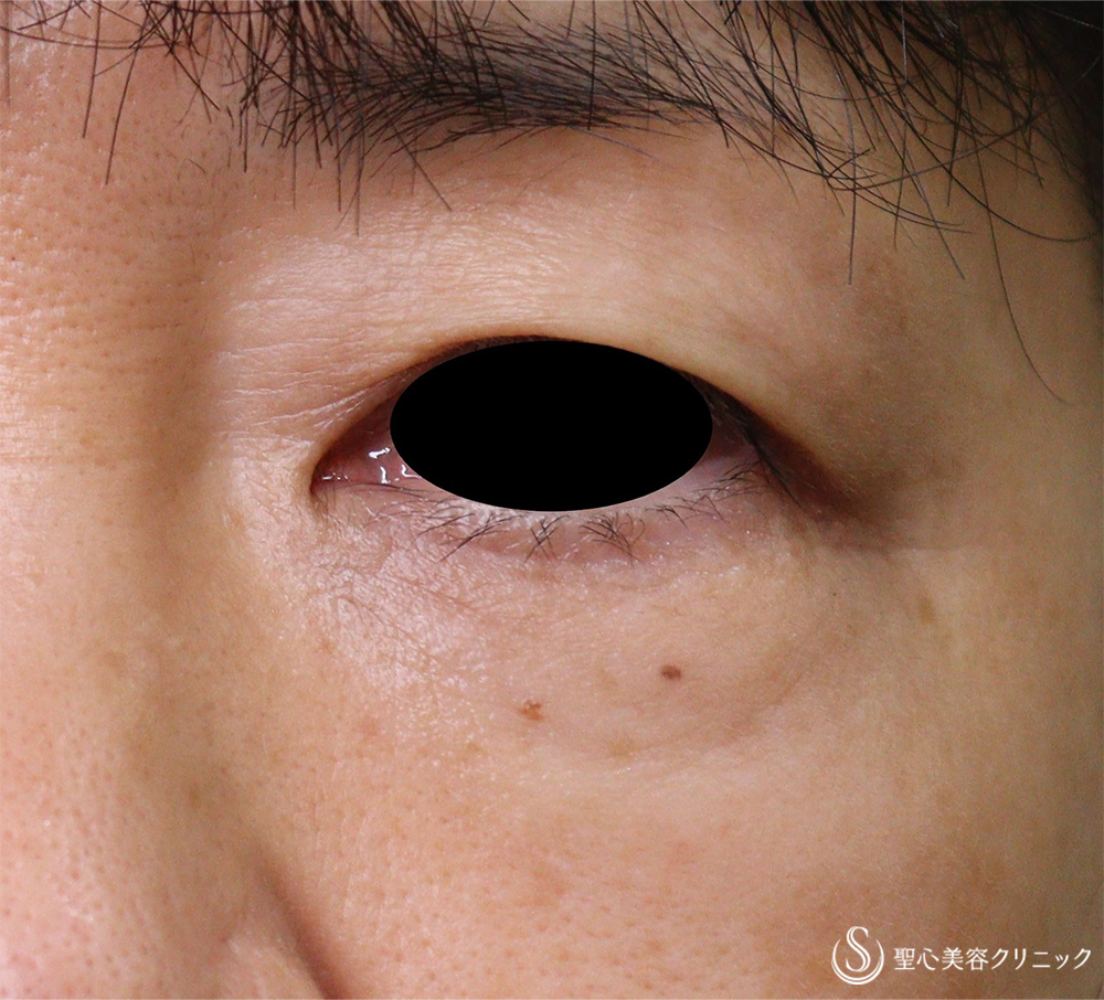 【50代女性・目の下の小じわ】プレミアムPRP皮膚再生療法（1年後） After 