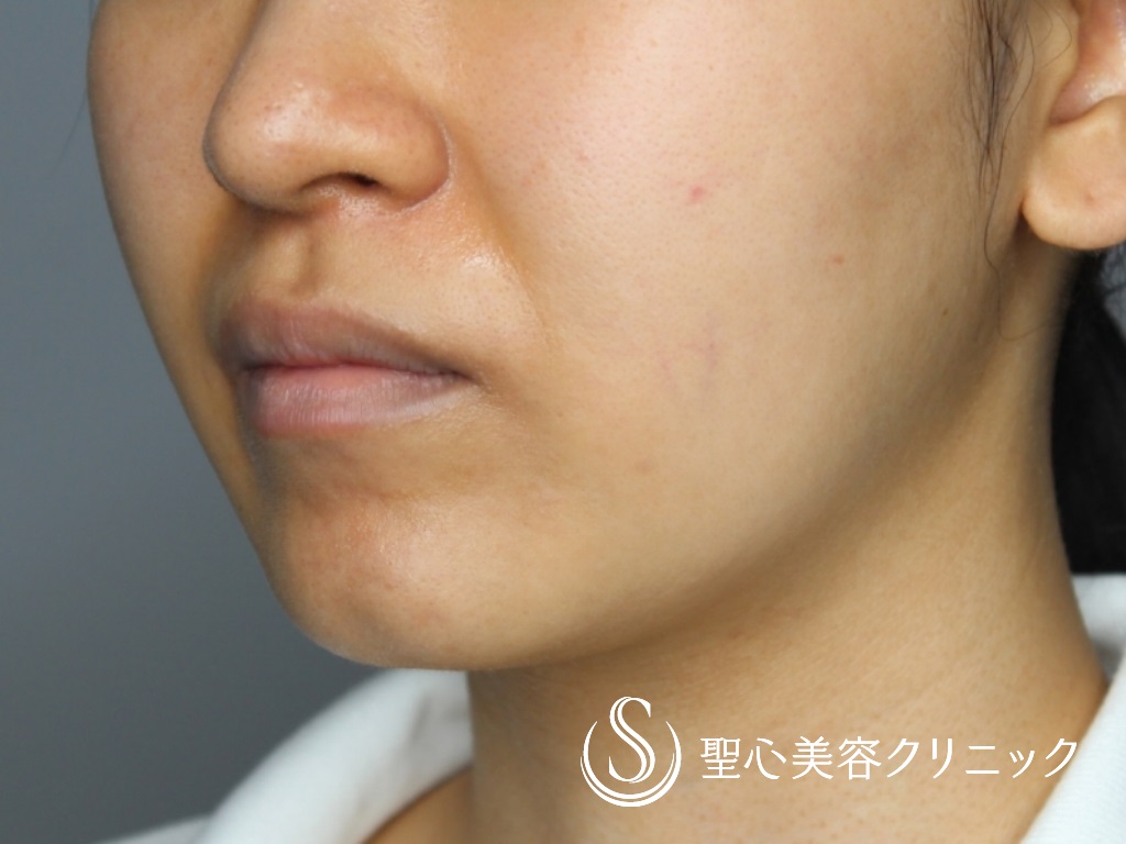 【20代女性・キュートな唇に！！】M字リップ+プレミアム口角挙上術（術後1か月） Before 
