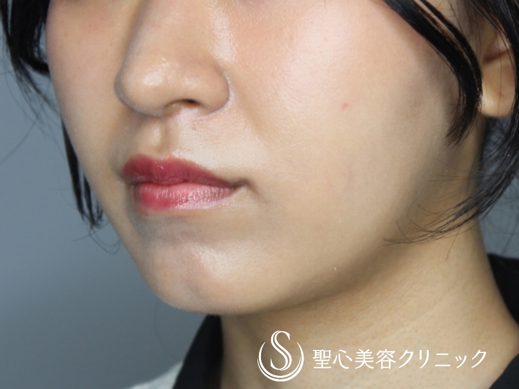 【20代女性・キュートな唇に！！】M字リップ+プレミアム口角挙上術（術後1か月） After 