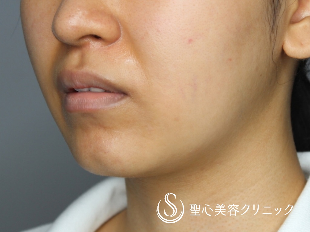 【20代女性・キュートな唇に！！】M字リップ+プレミアム口角挙上術（術後1か月） Before 