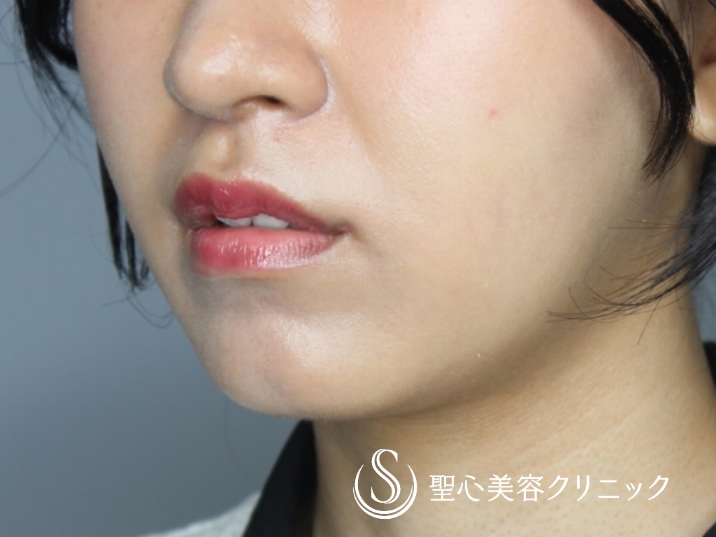 【20代女性・キュートな唇に！！】M字リップ+プレミアム口角挙上術（術後1か月） After 