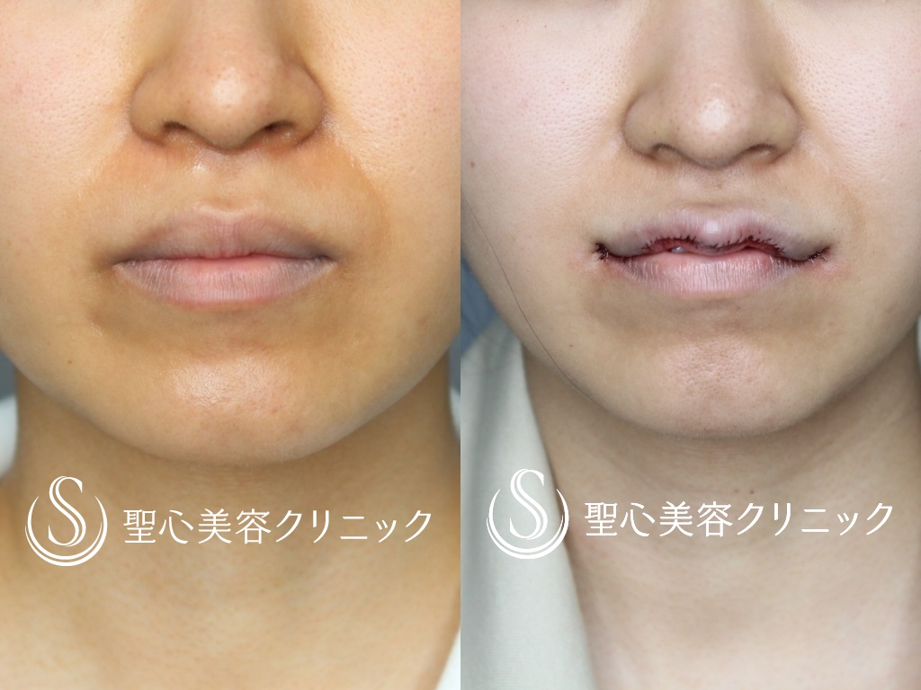 【20代女性・キュートな唇に！！】M字リップ+プレミアム口角挙上術（術後1か月） Before 