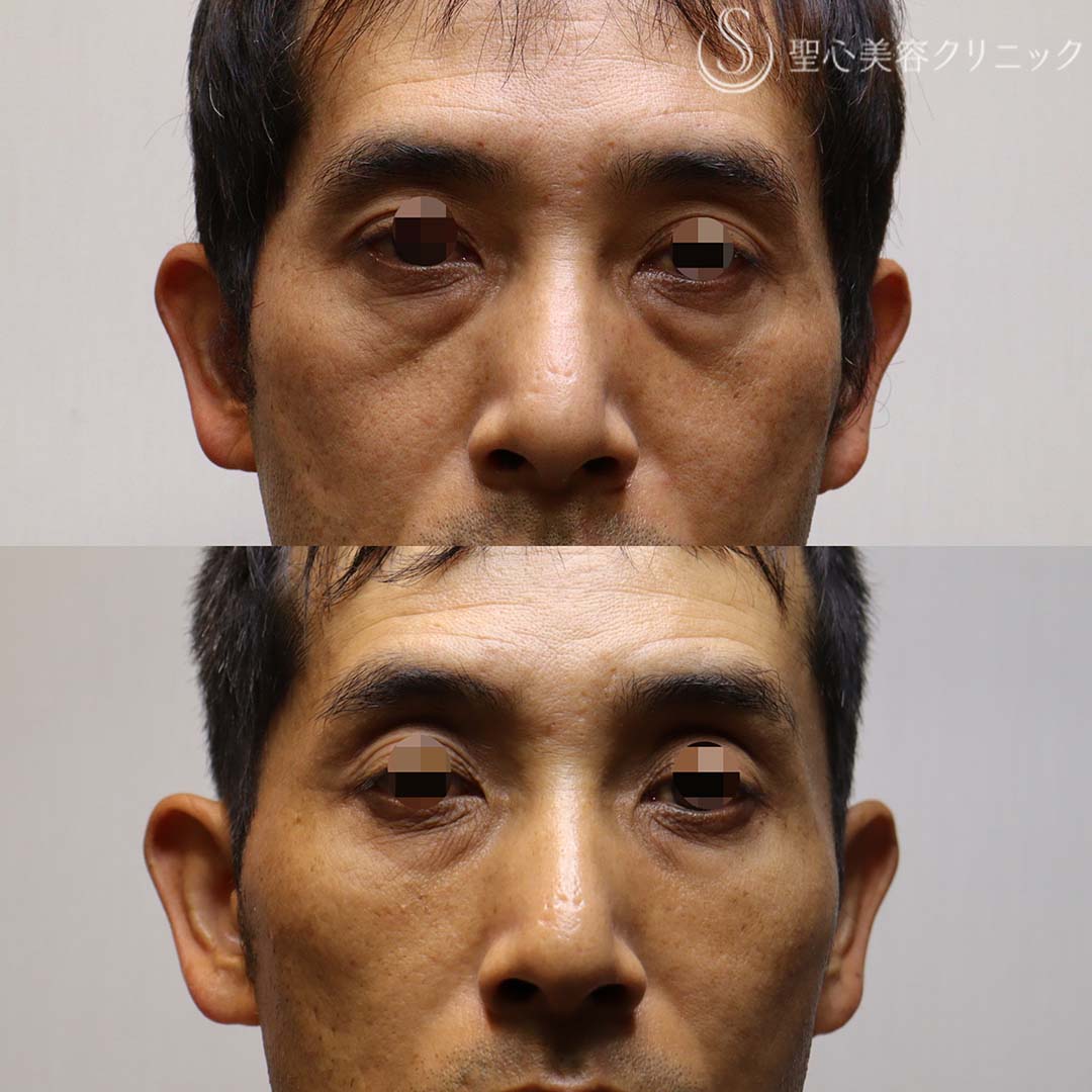 40代男性・凹みの目立つクマにはPRP治療】 プレミアムPRP皮膚