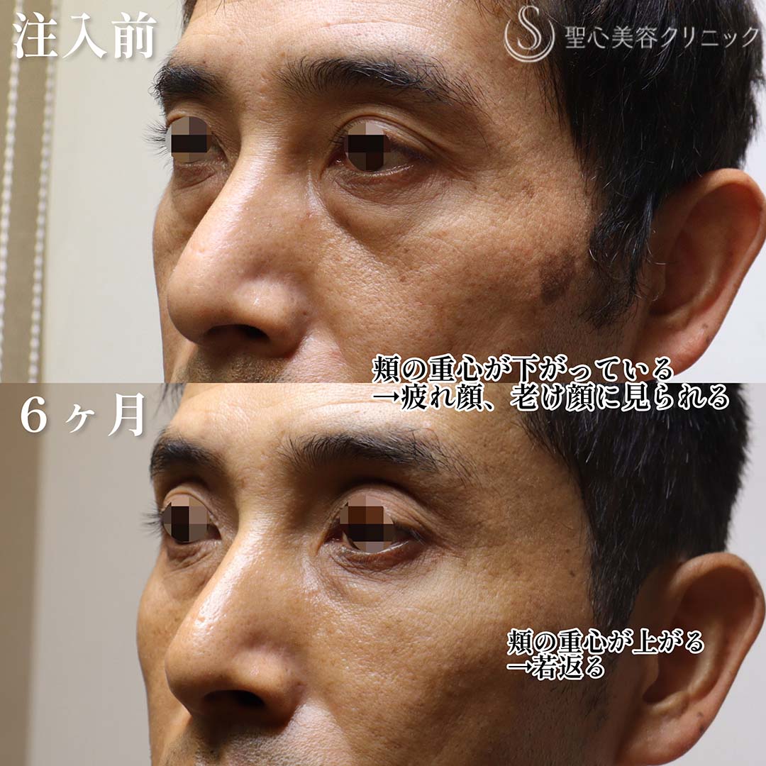 【40代男性・凹みの目立つクマにはPRP治療】 プレミアムPRP皮膚再生療法（6ヶ月後） After 