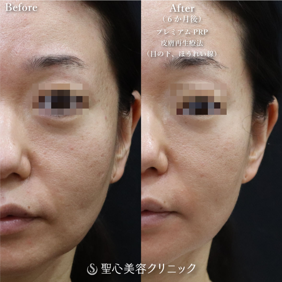 【40代女性・目の下とほうれい線で自然に若返り】プレミアムPRP皮膚再生療法（半年後） After 