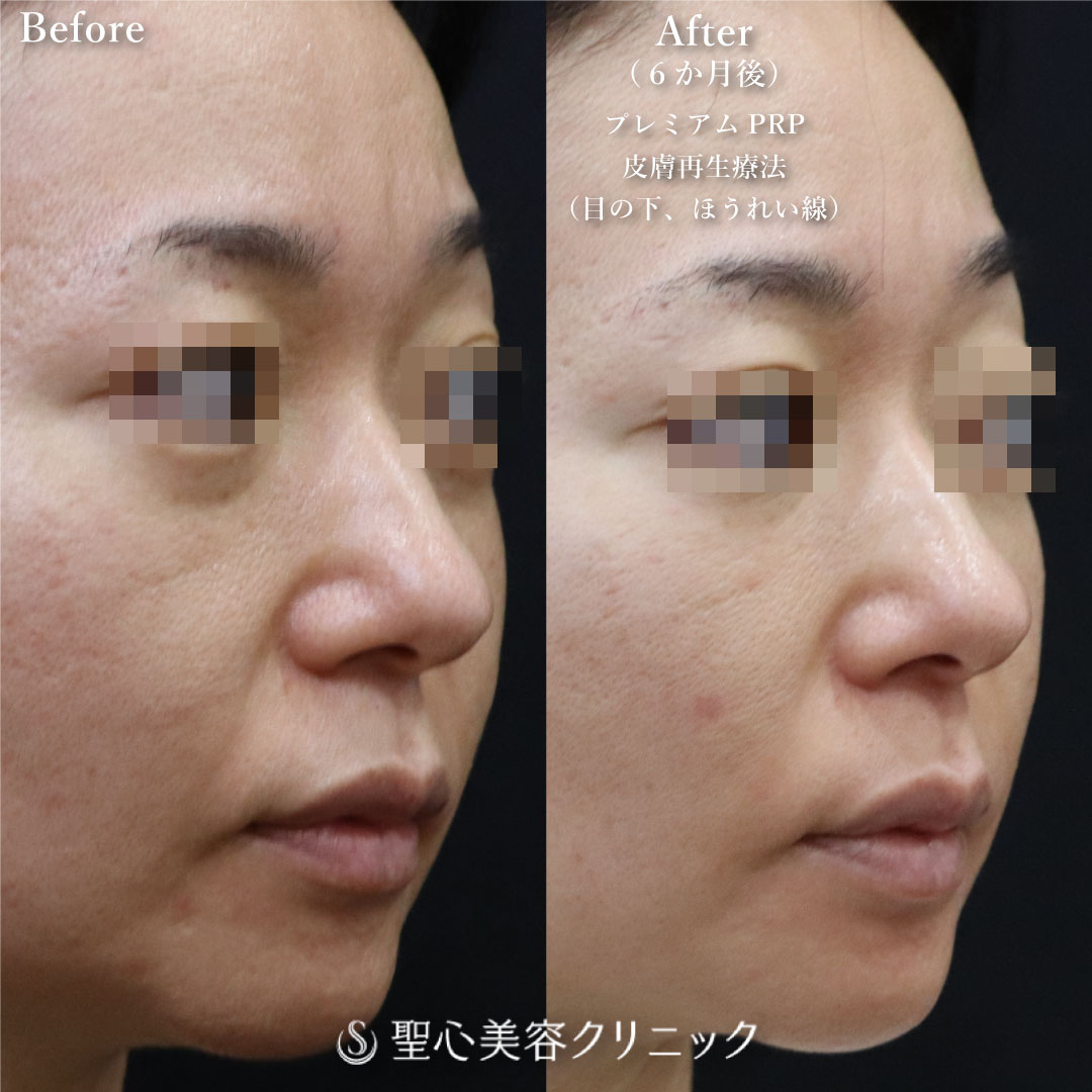 【40代女性・目の下とほうれい線で自然に若返り】プレミアムPRP皮膚再生療法（半年後） Before 