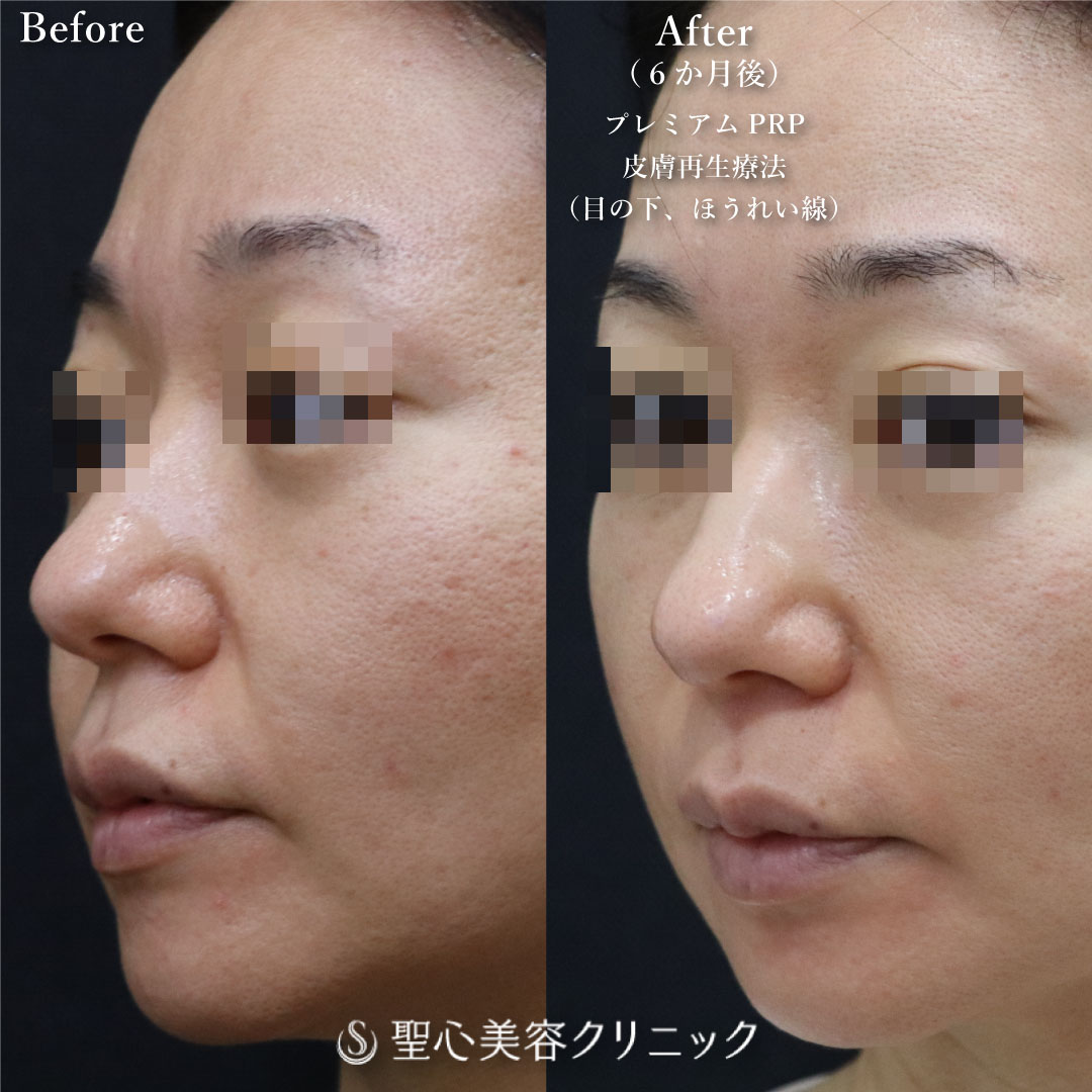 【40代女性・目の下とほうれい線で自然に若返り】プレミアムPRP皮膚再生療法（半年後） After 