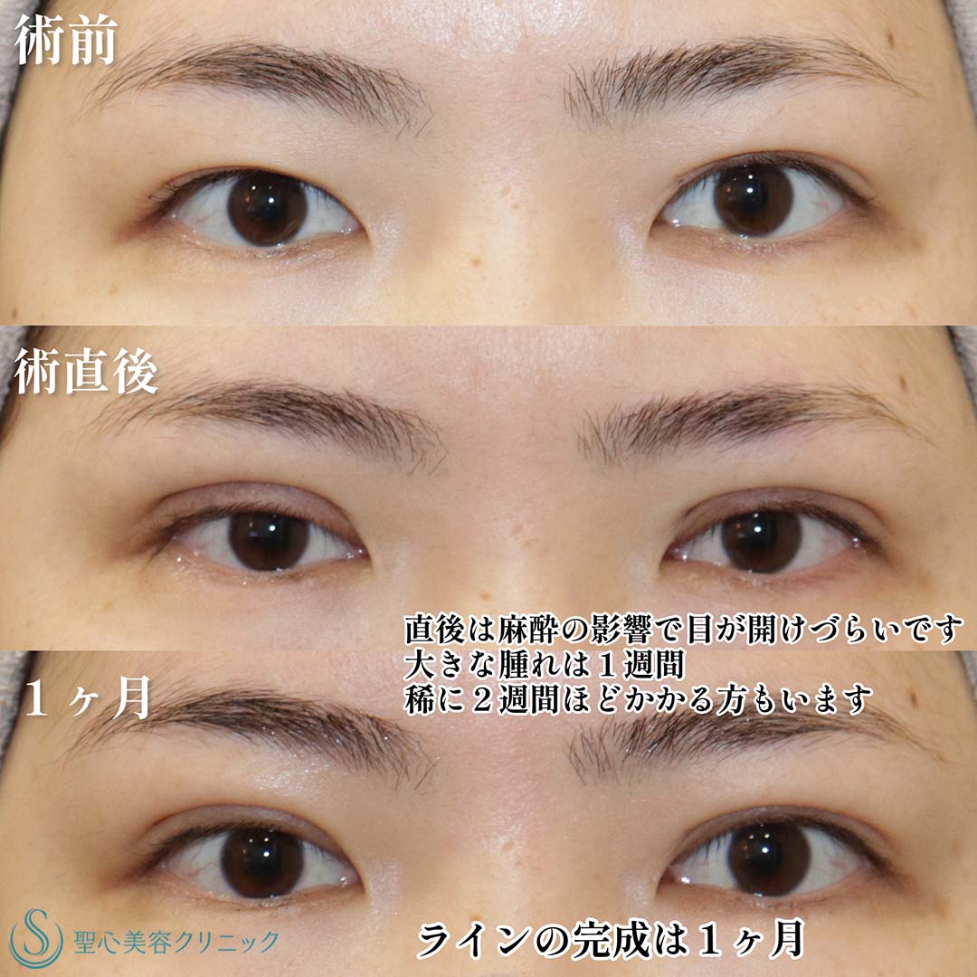 【20代女性・目頭から目尻までクッキリ二重に】 二重術（埋没法）：マイクロメソッド+α（1ヶ月後） Before 