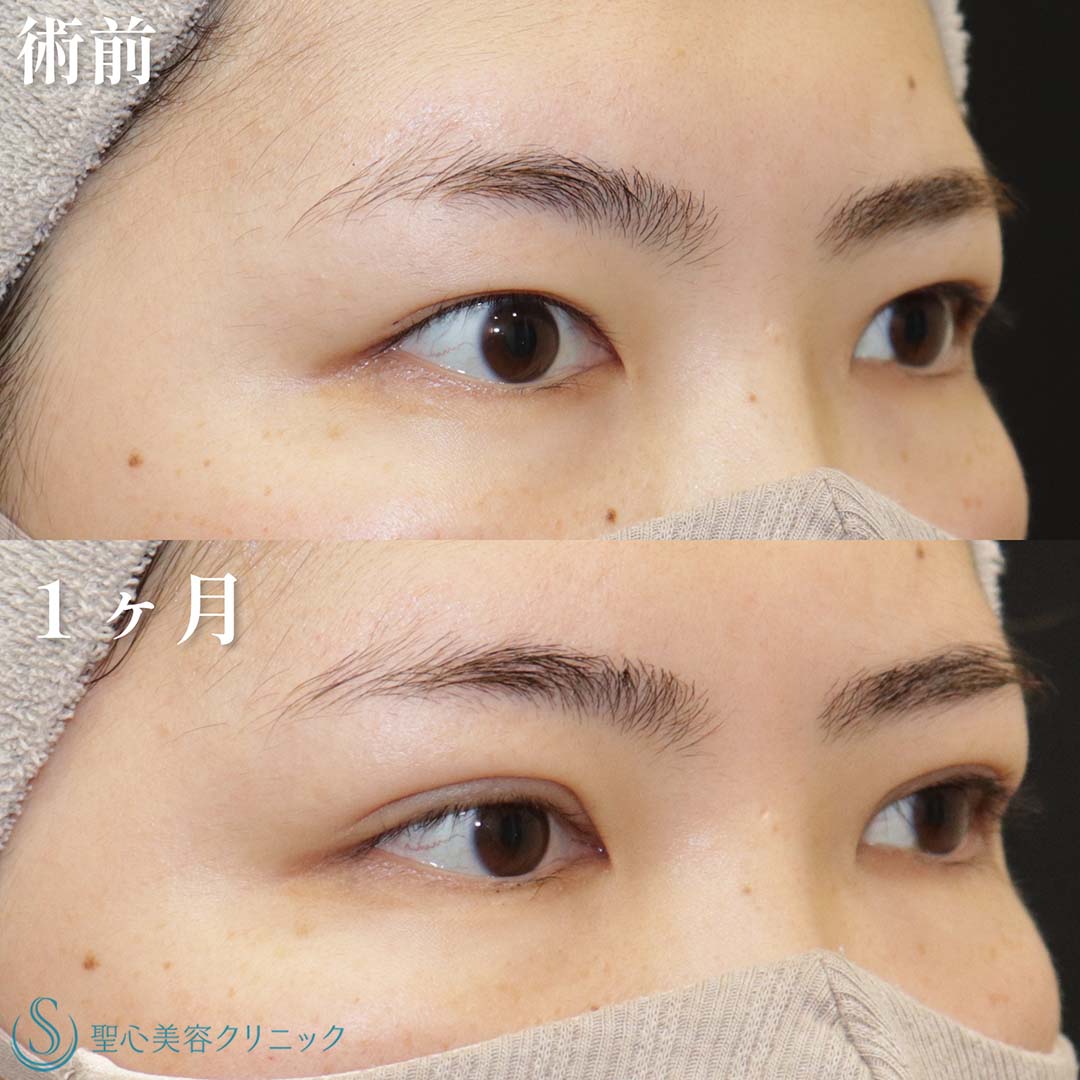 【20代女性・目頭から目尻までクッキリ二重に】 二重術（埋没法）：マイクロメソッド+α（1ヶ月後） After 