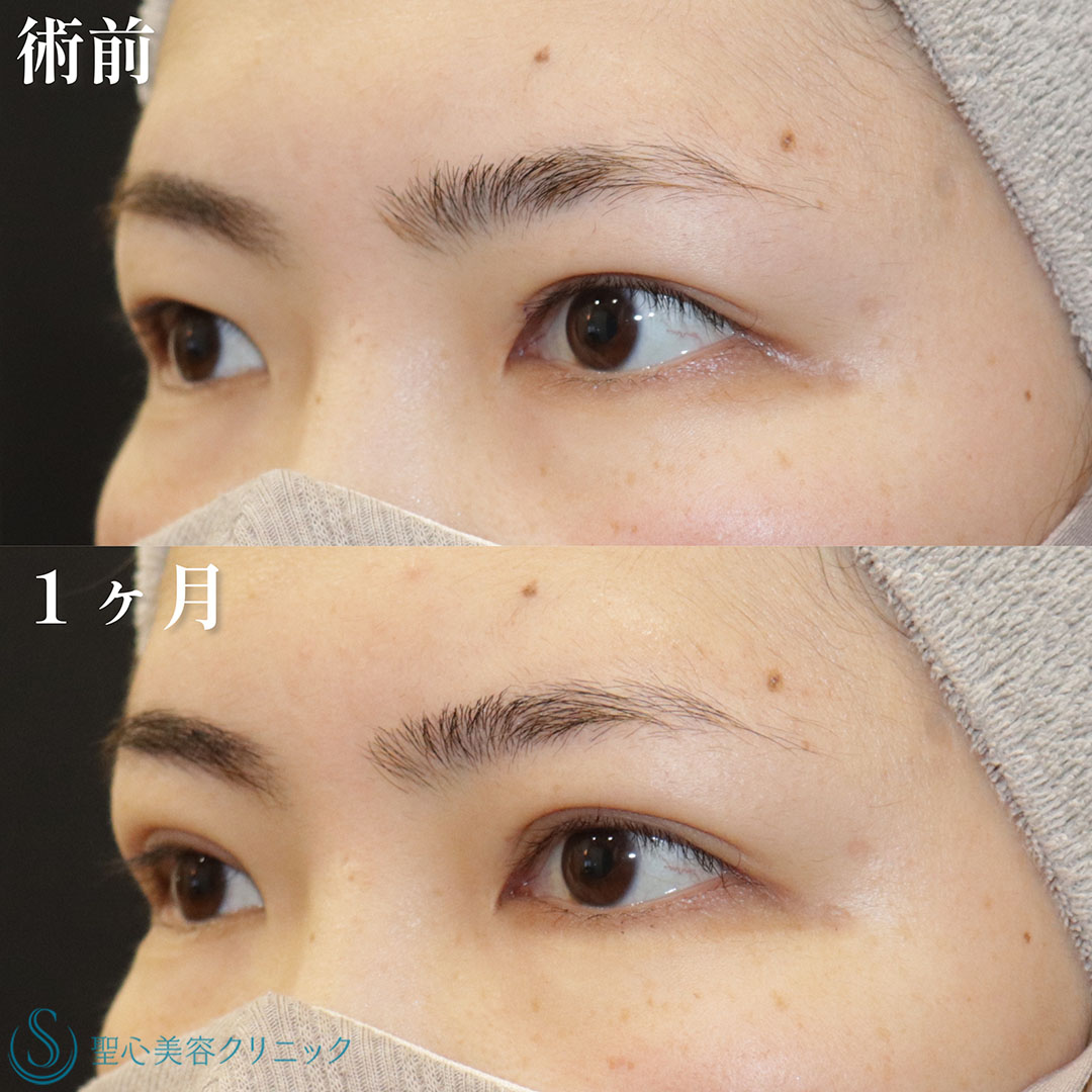 【20代女性・目頭から目尻までクッキリ二重に】 二重術（埋没法）：マイクロメソッド+α（1ヶ月後） After 