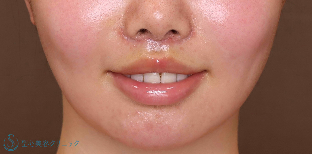【20代女性・人中を短くしたい！！】プレミアムリップリフト（プレミアム人中短縮術）（術後6日（抜糸時）） After 