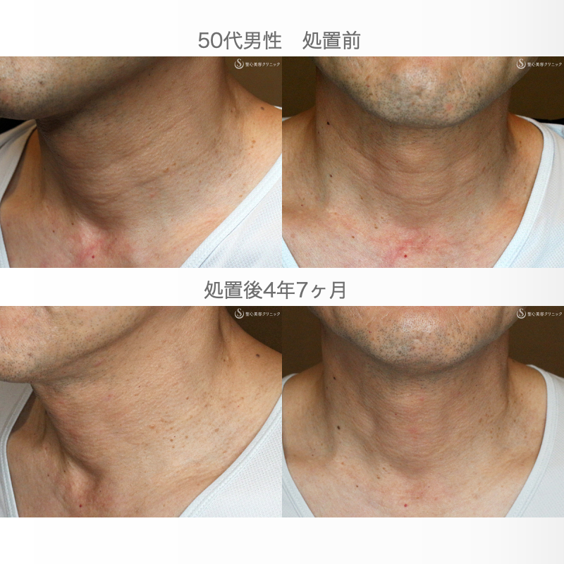 【50代男性・首の横じわは難しい】プレミアムPRP皮膚再生療法 単独（4年7ヶ月後） Before 