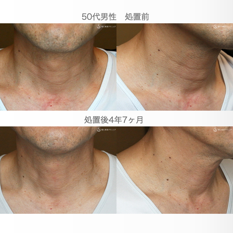 【50代男性・首の横じわは難しい】プレミアムPRP皮膚再生療法 単独（4年7ヶ月後） After 
