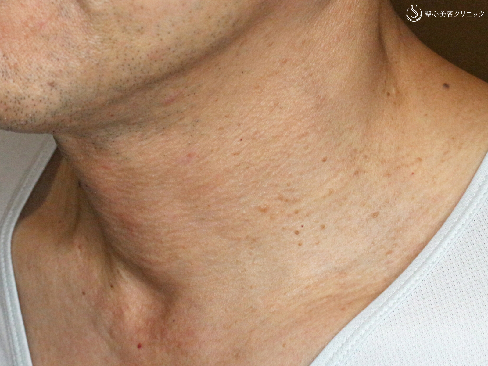 【50代男性・首の横じわは難しい】プレミアムPRP皮膚再生療法 単独（4年7ヶ月後） After 