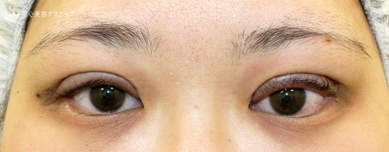 【20代女性・二重全切開に眼瞼下垂術式は必須】二重全切開+α法単独（3ヶ月後） Before 
