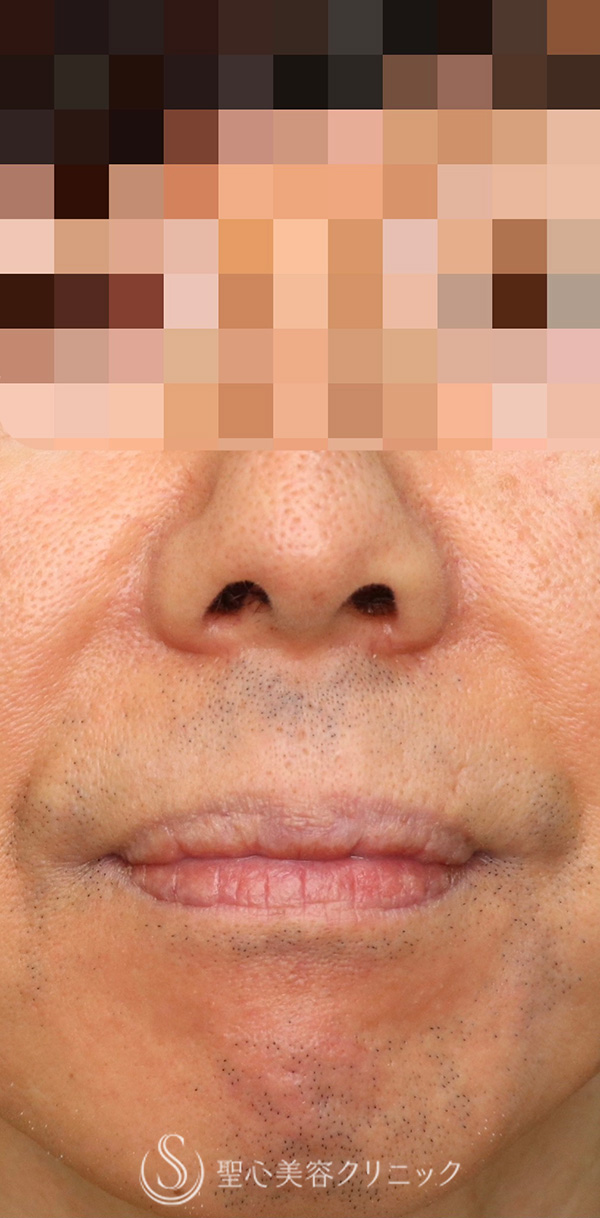【50代男性・口元のバランスを整えたい！！】プレミアムリップリフト（プレミアム人中短縮術）（術後1ヶ月） Before 