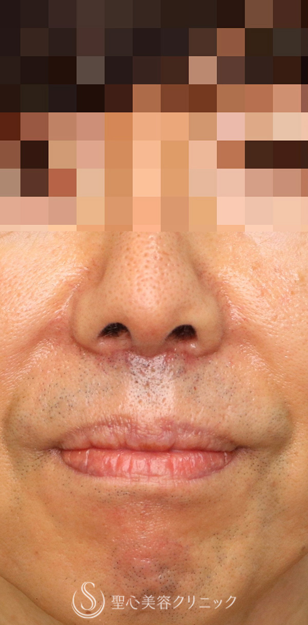【50代男性・口元のバランスを整えたい！！】プレミアムリップリフト（プレミアム人中短縮術）（術後1ヶ月） After 