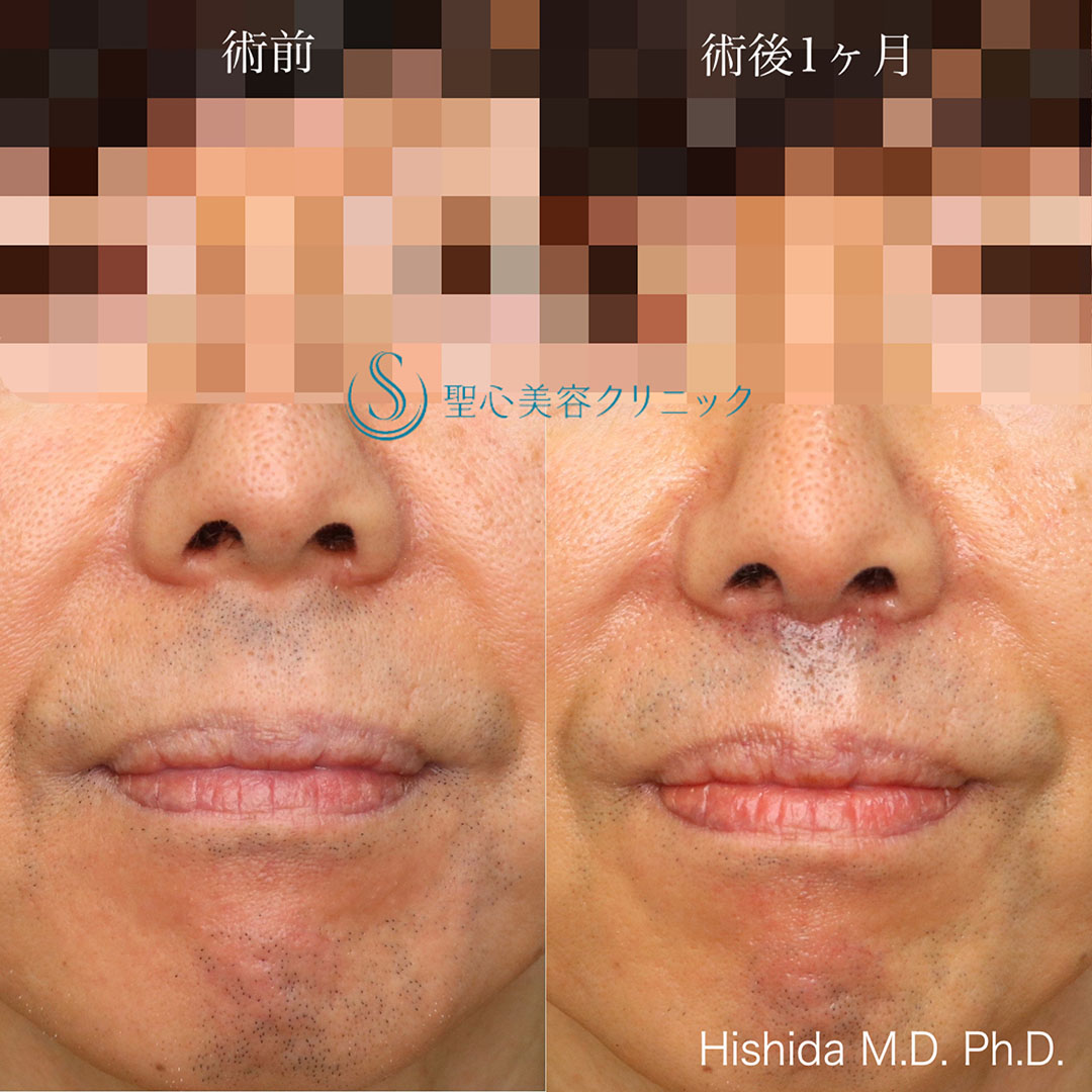 【50代男性・口元のバランスを整えたい！！】プレミアムリップリフト（プレミアム人中短縮術）（術後1ヶ月） After 