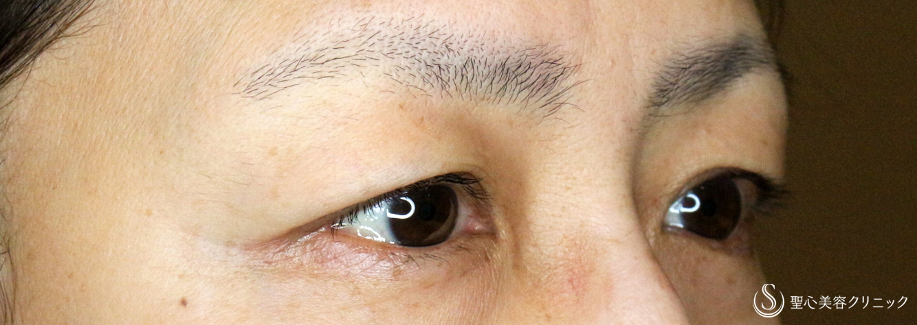 【50代女性・まぶたの自然な若返り】眉下リフト+α単独（1年6ヶ月後） Before 